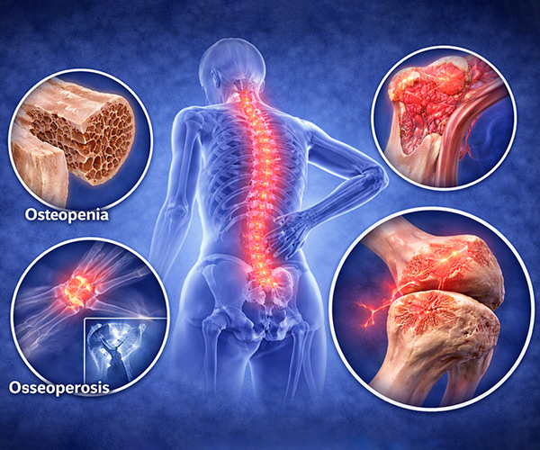 Doenças-Osteometabólicas